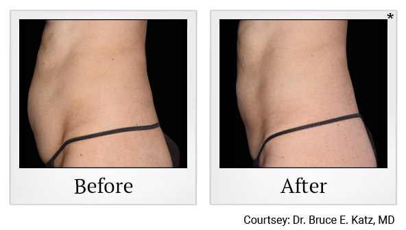 Emsculpt NEO results 1 at Rêve Body Sculpting in Louisville