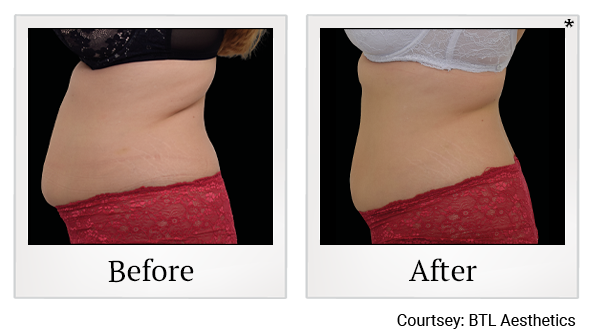 Emsculpt NEO results 2 at Rêve Body Sculpting in Louisville