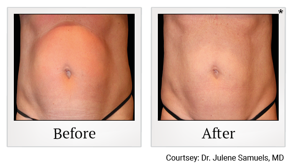 Emsculpt NEO results 3 at Rêve Body Sculpting in Louisville