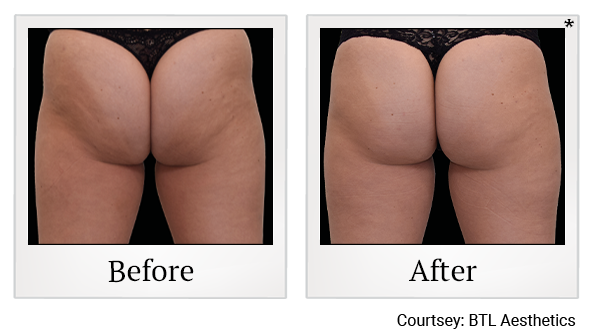 Emsculpt NEO results 4 at Rêve Body Sculpting in Louisville