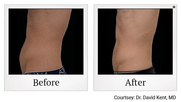 Emsculpt NEO results 5 at Rêve Body Sculpting in Louisville