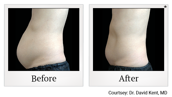 Emsculpt NEO results 6 at Rêve Body Sculpting in Louisville