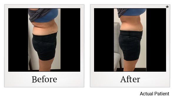 Results 1 of LED Light treatment at Rêve Body Sculpting in Louisville