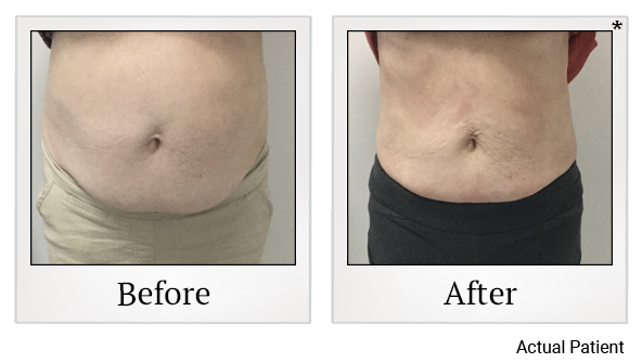 Results 2 of LED Light treatment at Rêve Body Sculpting in Louisville