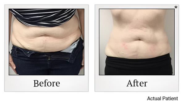 Results 3 of LED Light treatment at Rêve Body Sculpting in Louisville
