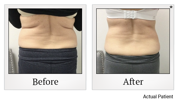 Results 4 of LED Light treatment at Rêve Body Sculpting in Louisville