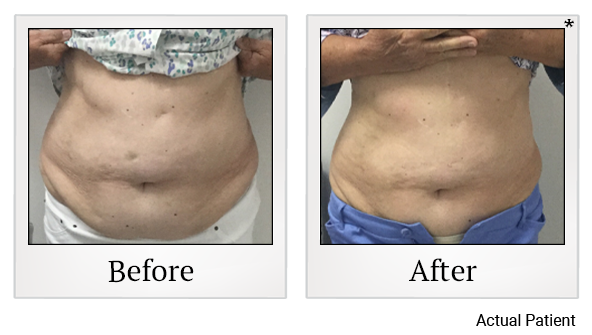 Results 5 of LED Light treatment at Rêve Body Sculpting in Louisville