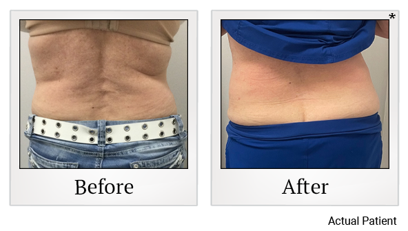 Results 6 of LED Light treatment at Rêve Body Sculpting in Louisville